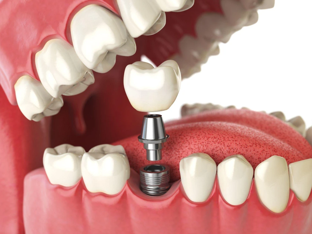 All-on-6 Dental Implants
