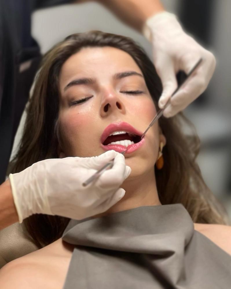 Cosmetic dental treatment performed on a female patient at Auraliss Health Antalya