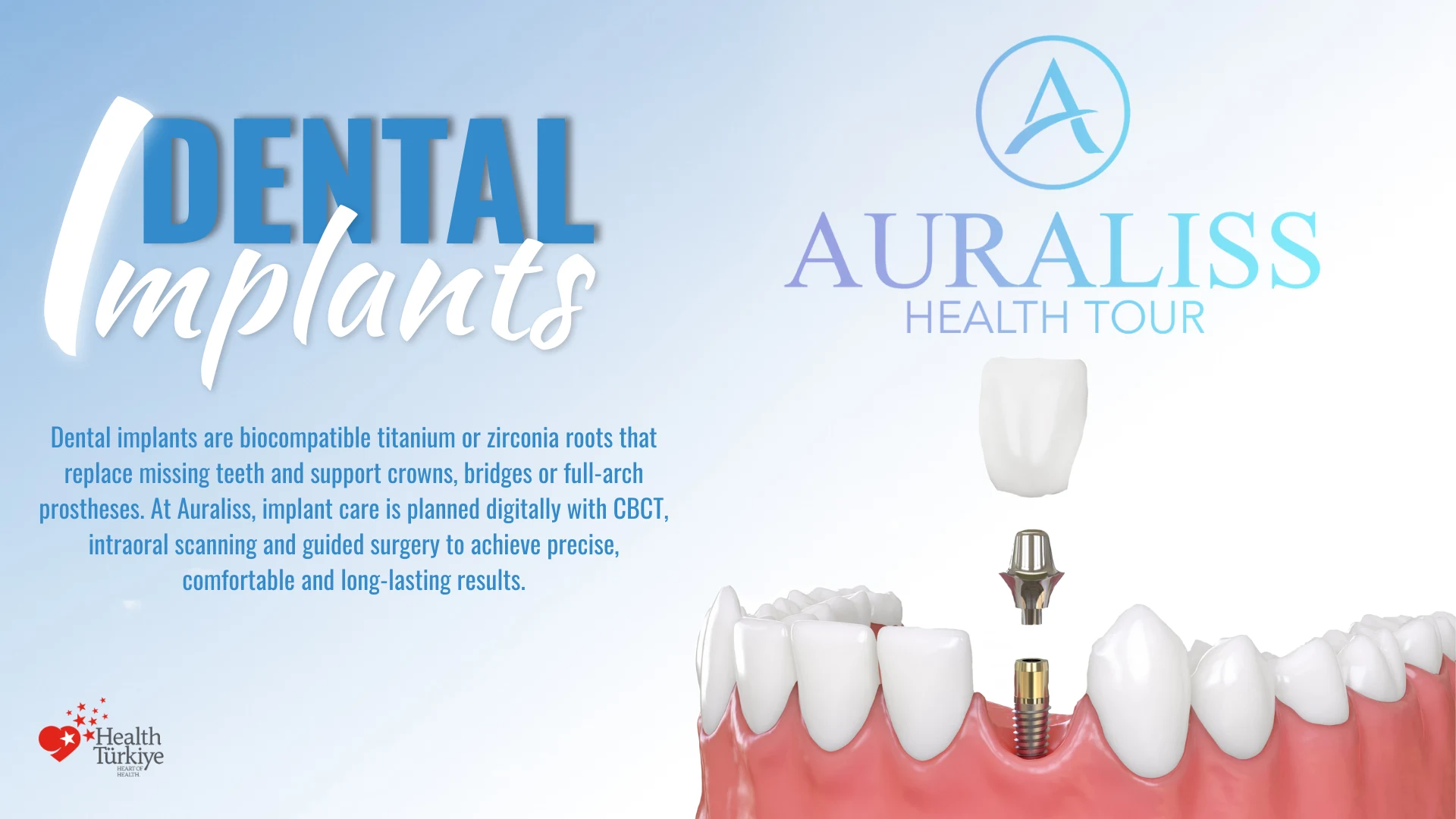 All-on-4 Dental Implants