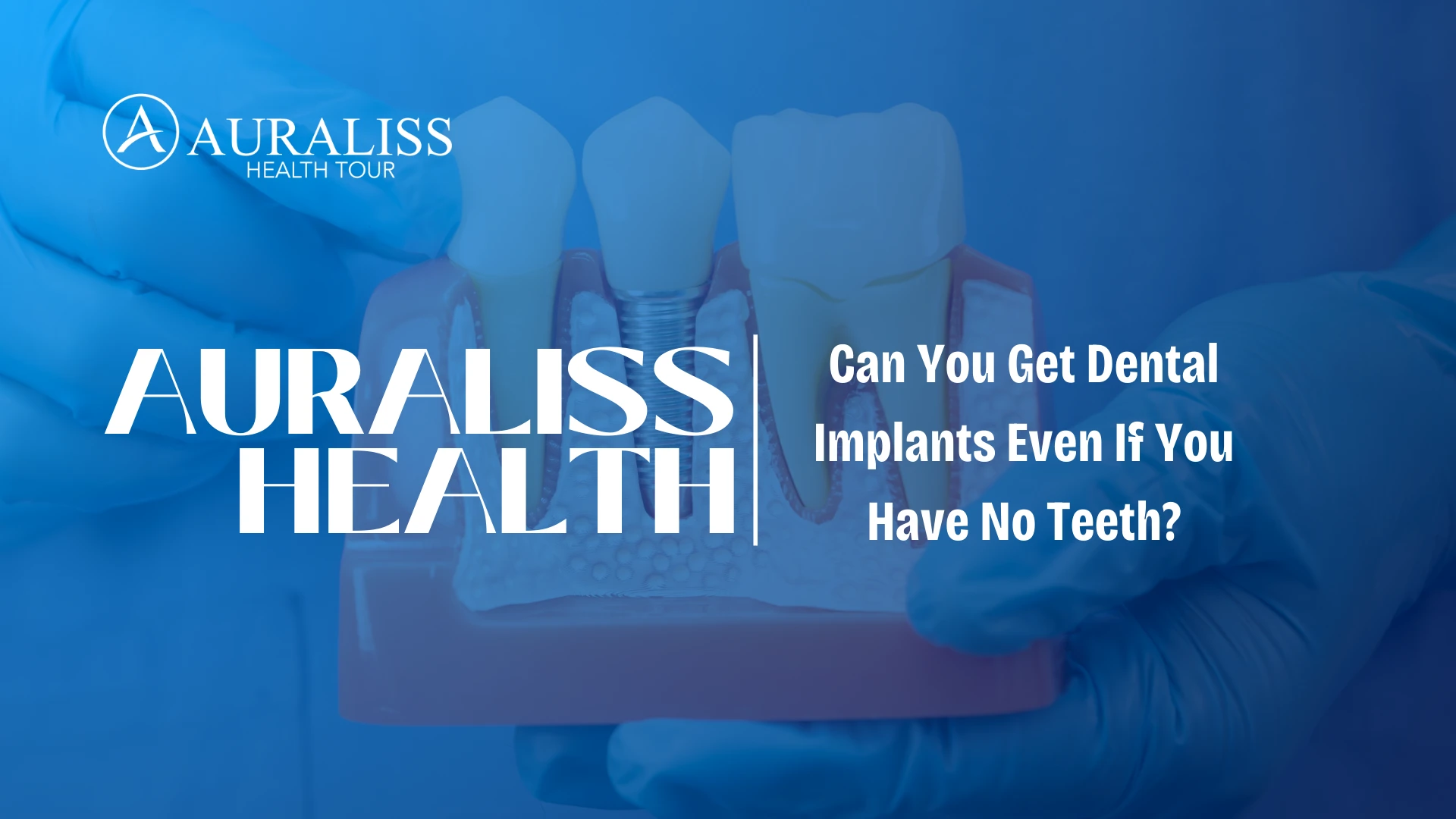 Can You Get Dental Implants Even If You Have No Teeth? Full Edentulism Implant Treatment Guide 2 Can You Get Dental Implants Even If You Have No Teeth