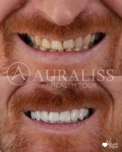 Before - After