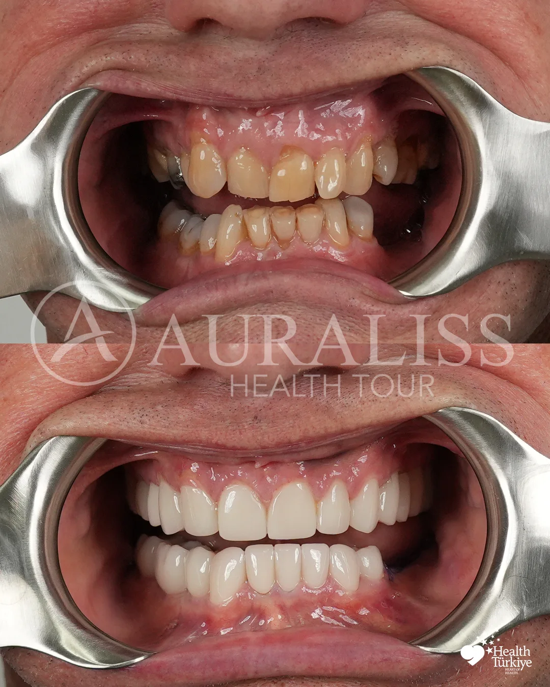 Hollywood smile makeover before and after dental treatment result case 13