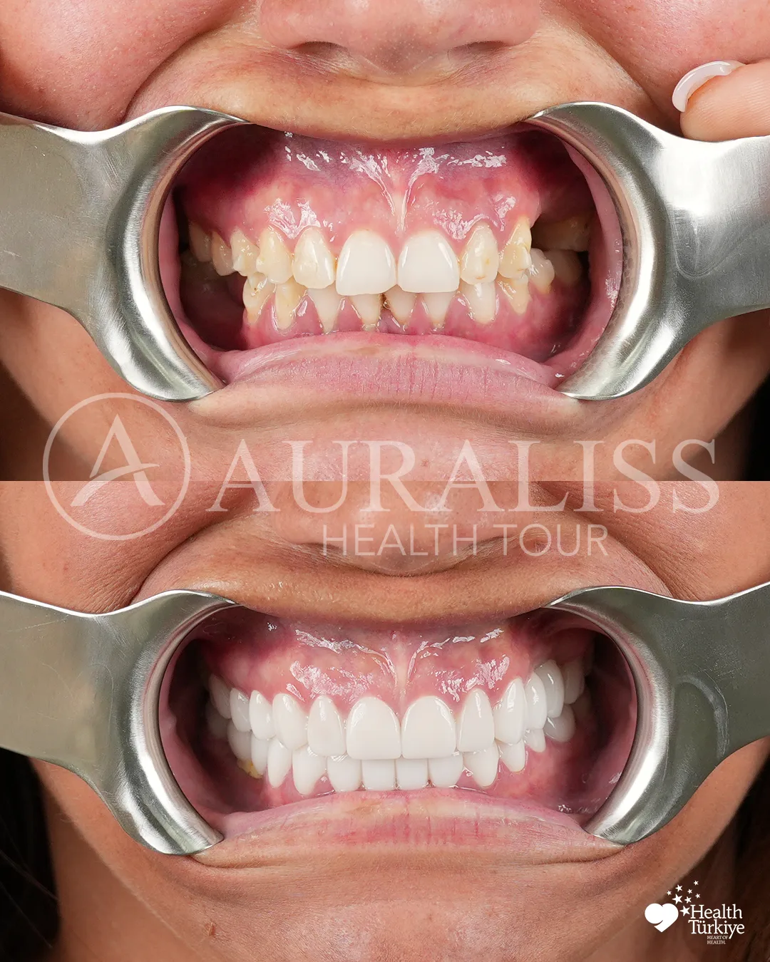 Hollywood smile before and after dental treatment result case 06
