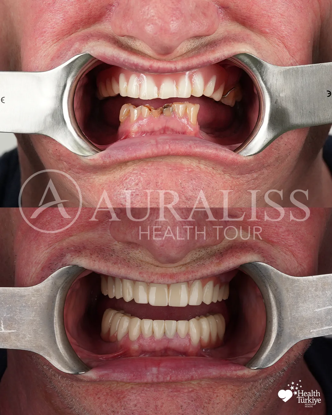 Smile design before and after dental treatment result case 07