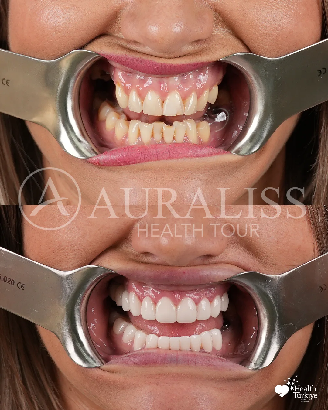 Full mouth restoration before and after dental treatment result case 05
