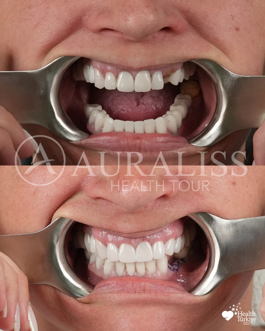 Restorative dentistry before and after dental treatment result case 11