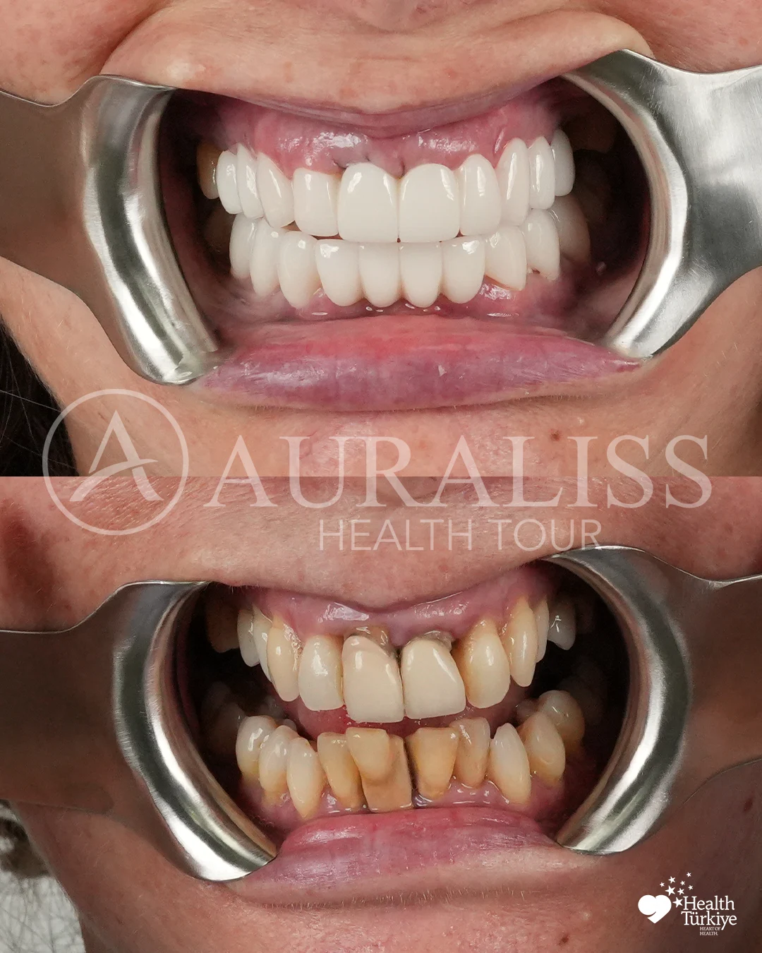 Smile makeover and gum treatment before and after dental treatment result case 12