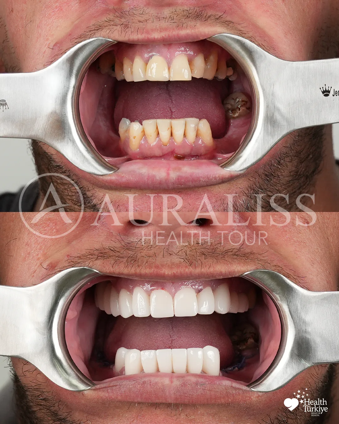 Smile makeover treatment progress before and after dental treatment result case 02
