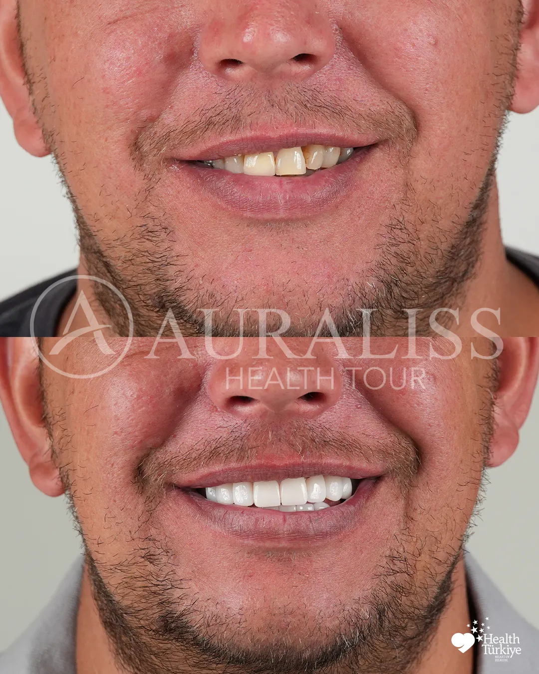 Smile makeover before and after dental treatment result case 04