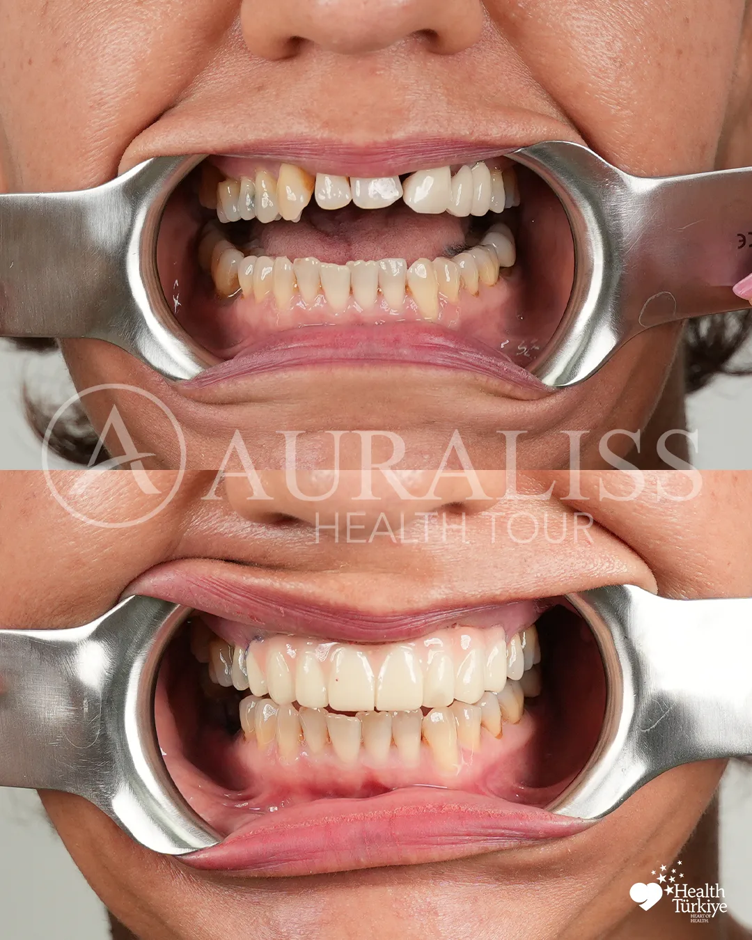 Dental restoration before and after dental treatment result case 03