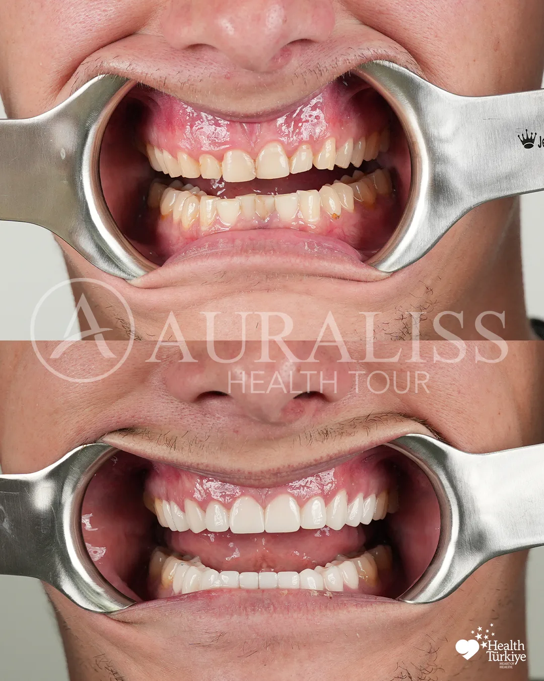 Hollywood smile before and after dental treatment result case 01
