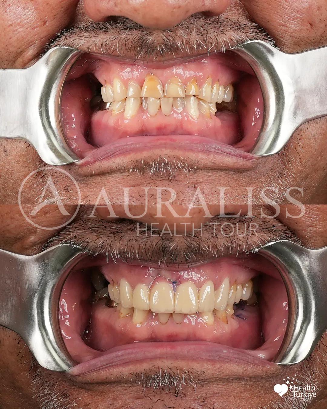 Dental function restoration before and after dental treatment result case 14