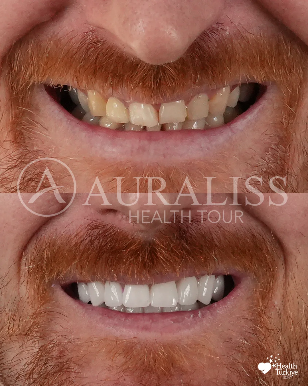 Zirconium smile makeover before and after dental treatment result case 09