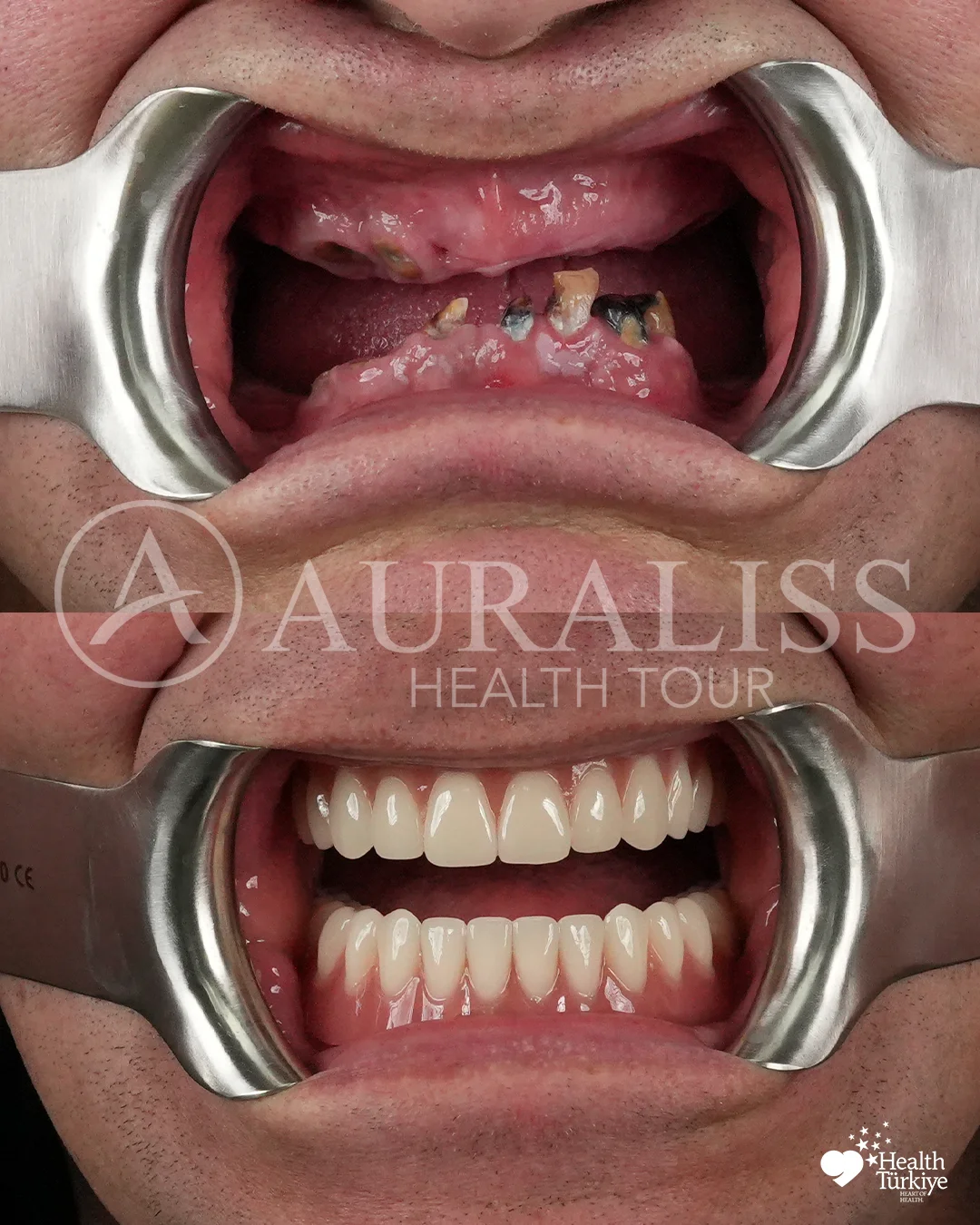 All on 6 dental implants before and after dental treatment result case 10