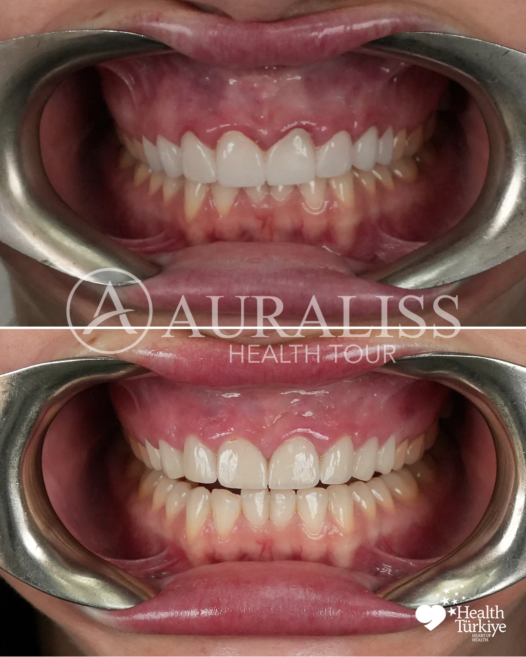 Natural smile makeover before and after dental treatment result case 08